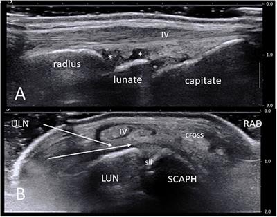 Ultrasound-Guided Synovial Biopsies of Wrists, Metacarpophalangeal, Metatarsophalangeal, Interphalangeal Joints, and Tendon Sheaths